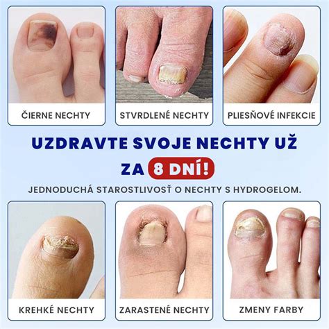 Porovnanie zdravých a poškodených nechtov