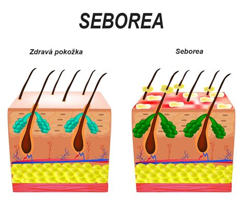 Ilustrácia zdravej a poškodenej pokožky hlavy
