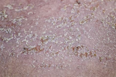 Mapa tela znázorňujúca oblasti náchylné na seboroickú dermatitídu