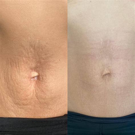 Vznik strií na tele