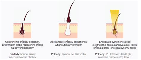 Ilustrácia rôznych metód odstraňovania chĺpkov