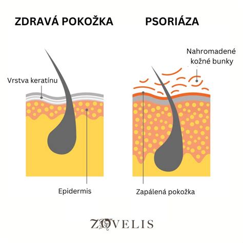 Schéma vzniku mikrozápalu na pokožke hlavy