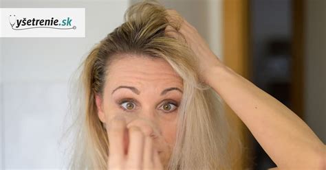 Vypadávajúce vlasy