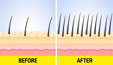 Ilustrácia poškodených vlasových folikulov