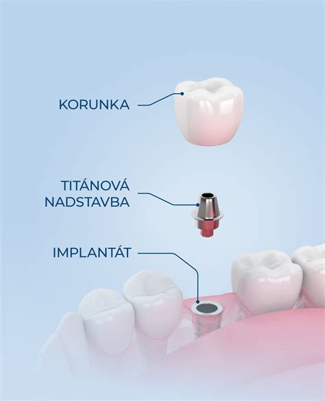 Štruktúra zubného implantátu