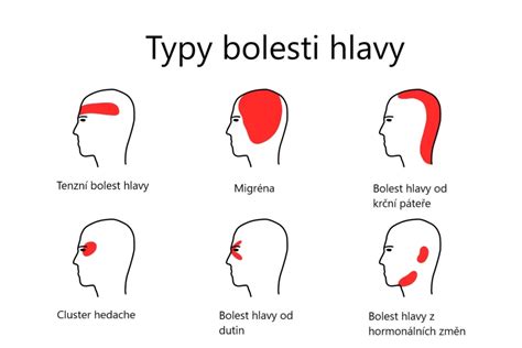 Infografika o rôznych typoch bolesti hlavy