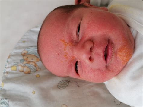 Ilustrácia mliečnej chrasty u novorodenca