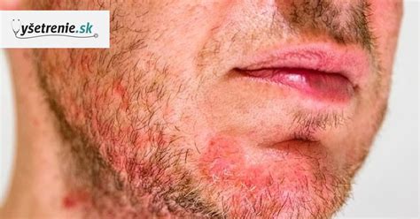 Seboroická dermatitída na tvári dospelého