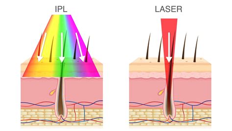 Rozdiel medzi laserom a IPL