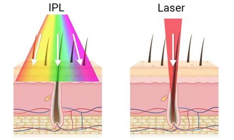 Ilustrácia princípu fungovania IPL epilácie