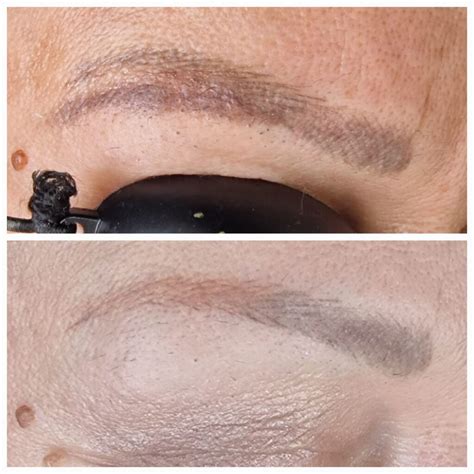 Laserové odstránenie tetovania obočia