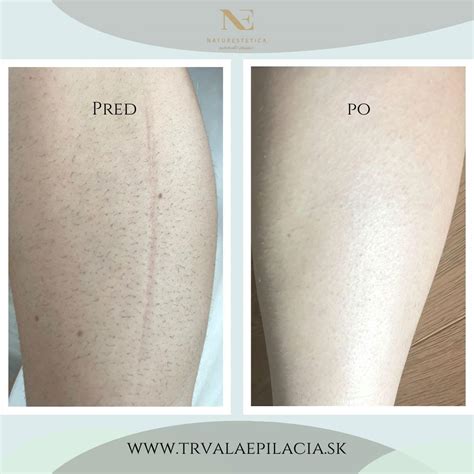 Ilustrácia hladkej pokožky po odstránení chĺpkov