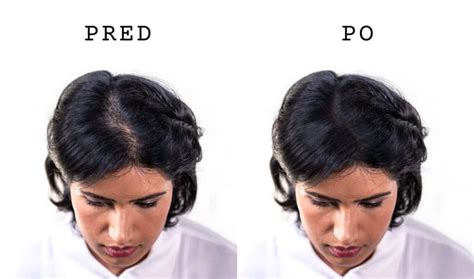 Porovnanie vzhľadu vlasov pred a po použití Nanogen