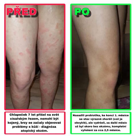 Prevalencia atopického ekzému u detí