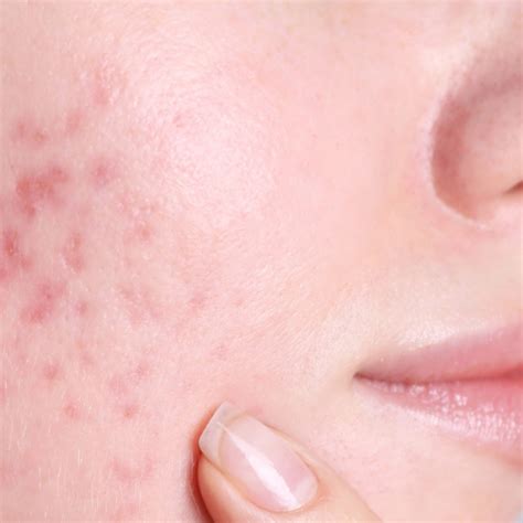 prípravky na starostlivosť o aknóznu pleť