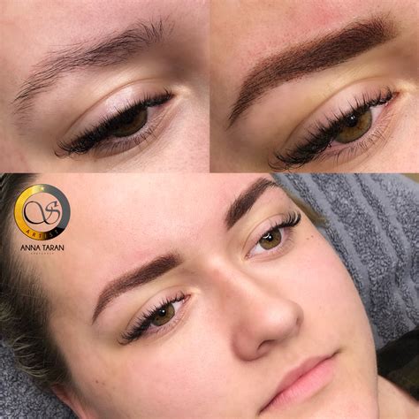 Alergická reakcia po kozmetickom zákroku na obočí