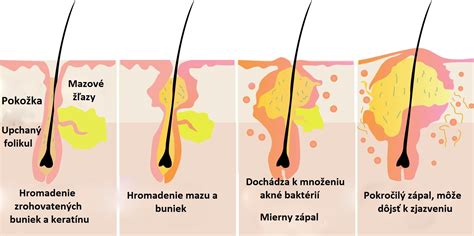 Ilustrácia mazových žliaz na koži