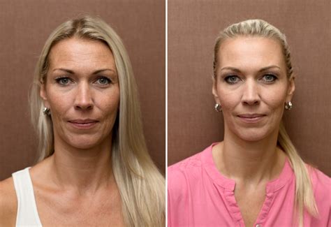 Fotografia porovnania pleti pred a po absolvovaní kúry fotorejuvenizácie