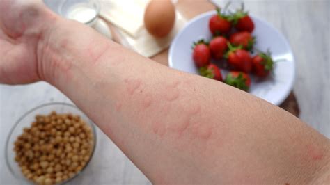 Vizualizácia kontaktnej alergickej reakcie na koži
