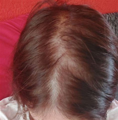 Schéma: Faktory ovplyvňujúce jemné a riedke vlasy (genetika, hormóny, stres, výživa, starostlivosť)