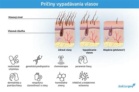 Schéma zobrazujúca rôzne príčiny vypadávania vlasov