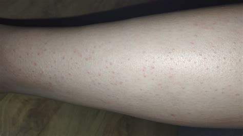 Podráždená pokožka s vyrážkami po holení