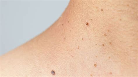 Detail psoriatických plakov na koži