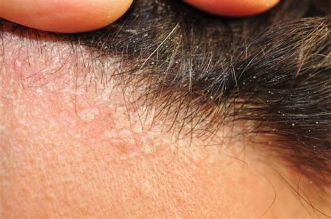 Detailný záber na prejavy seboroickej dermatitídy na pokožke hlavy