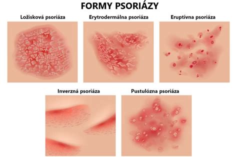 Ilustrácia pokožky hlavy s plakmi psoriázy