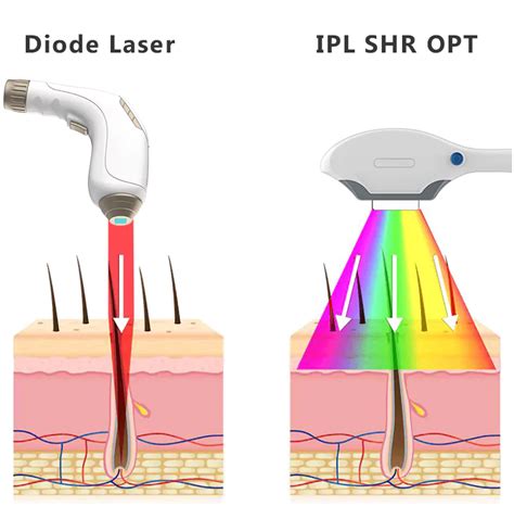 Schéma porovnania IPL, OPT a SHR technológií