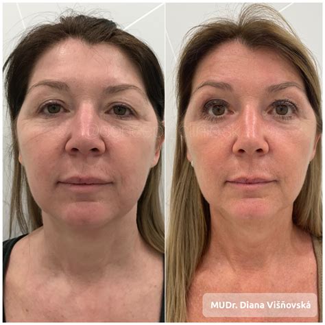 Porovnanie pred a po Ultherapy Browlift