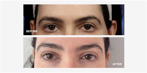 Infografika porovnávajúca chirurgický a neinvazívny brow lift