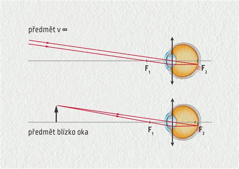 schéma lomivosti svetla v oku s astigmatizmom a po korekcii okuliarmi
