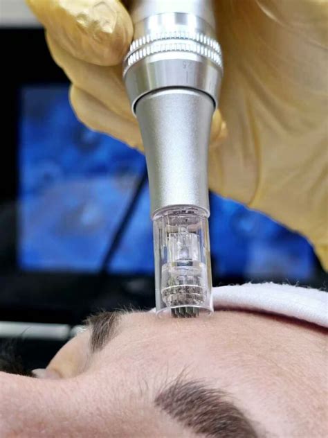 ilustrácia mezoterapie tváre pre regeneráciu pleti