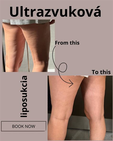 Ilustrácia zarastených chĺpkov a podráždenej pokožky