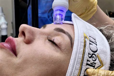 IPL ošetrenie tváre s ochrannými okuliarmi