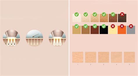 Porovnanie typov pleti a farieb chĺpkov vhodných pre IPL