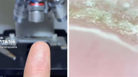 Detailný záber na jemné a oslabené vlasy pod mikroskopom