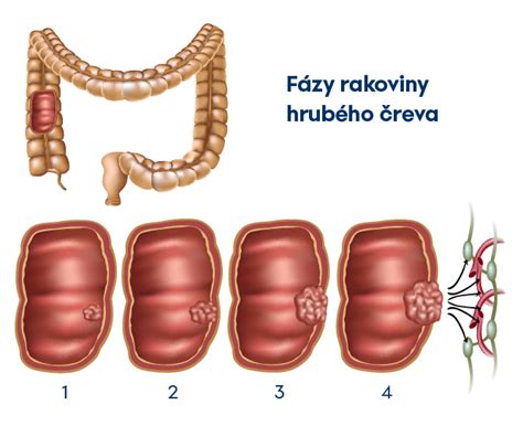 postup pri endoskopickom vyšetrení tenkého čreva