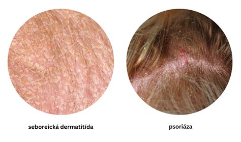 Duhringova dermatitída na lakti