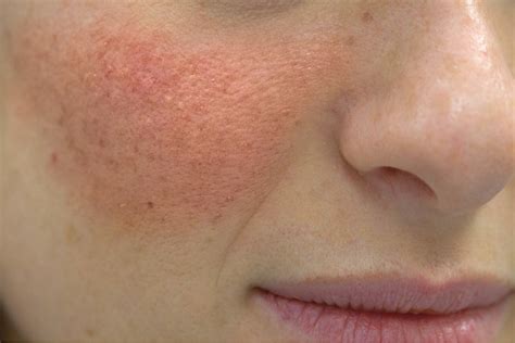 Schéma lokalizácie seboroickej dermatitídy na tele