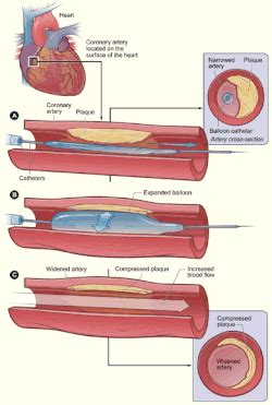 Schéma postupu perkutánnej koronárnej angioplastiky: zavedenie katétra, nafúknutie balónika a rozšírenie zúženého miesta
