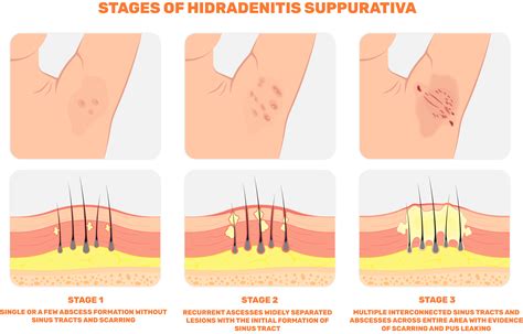 Ilustrácia hidradenitis suppurativa