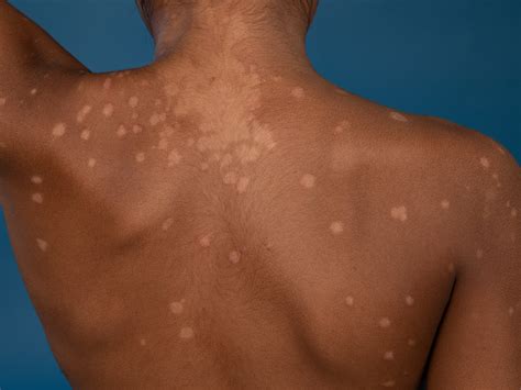 Kožné lézie pityriasis versicolor