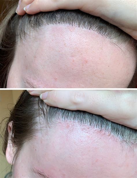 Detailný pohľad na štruktúru vlasov po aplikácii kofeínovej starostlivosti