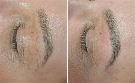 Schéma znázorňujúca proces zdvihnutia obočia pri endoskopickom lifte