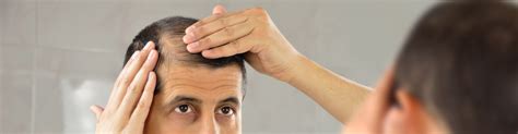 Najčastejšie príčiny vypadávania vlasov u mužov
