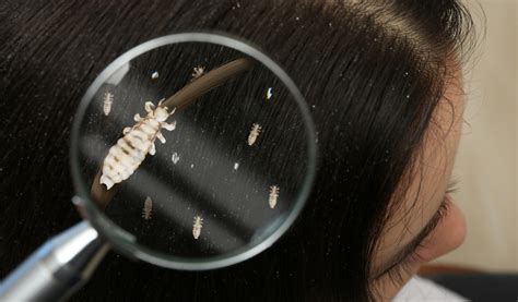 Ilustrácia vší vo vlasoch