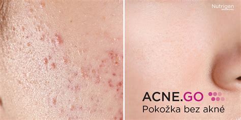 Obrázok pleti s akné pred a po aplikácii prípravkov so žihľavou