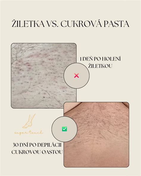 Ilustrácia hladkej pokožky po depilácii